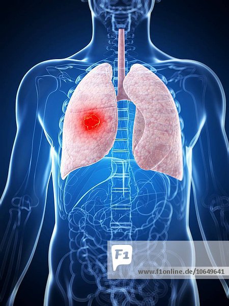 Human lung cancer artwork