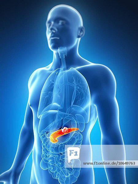Human pancreas showing tumor artwork