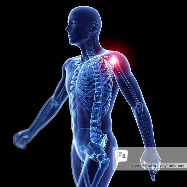 Human shoulder pain  artwork