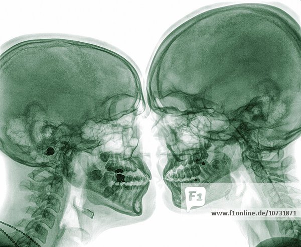 Mensch Zwei Personen Menschen Kussen Unterhalb 2 Rontgen
