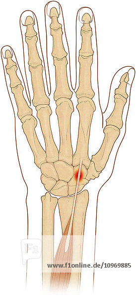 Anterior view of hand bones with inflammed extensor carpi radialis longus muscle