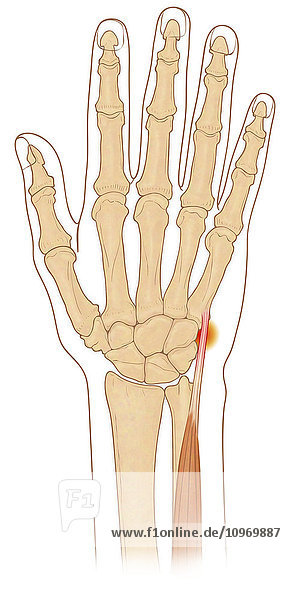 Anterior view of hand bones with inflamed extensor carpi ulnaris muscle