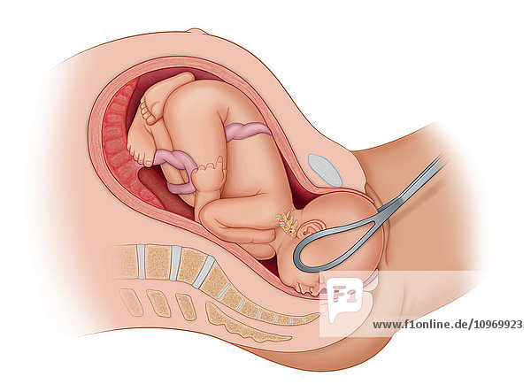 Cross section of the mother's anatomy showing the baby in uteruo LOA being delivered normally via the use of forceps turning head from Loa to Oa for normal delivery