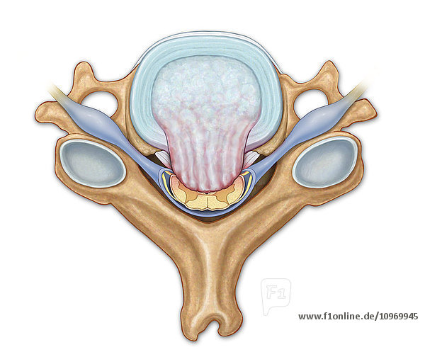 Axial view of C5 showing herniated disk  compressed spinal cord and nerve roots  posterior and anterior longitudinal ligaments