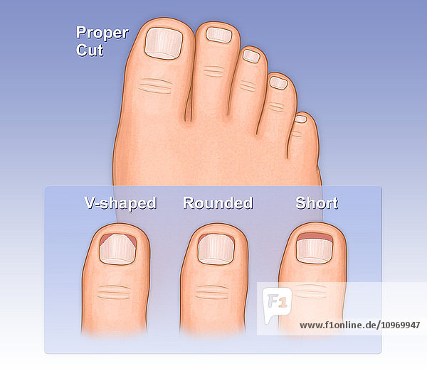 Showing a proper way to cut toe nails versus and improper way  shown as a rounded cut  v-shaped cut or short cut toe nails
