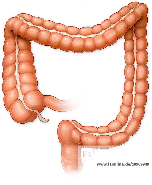 Anterior view of large intestine with diverticulitis