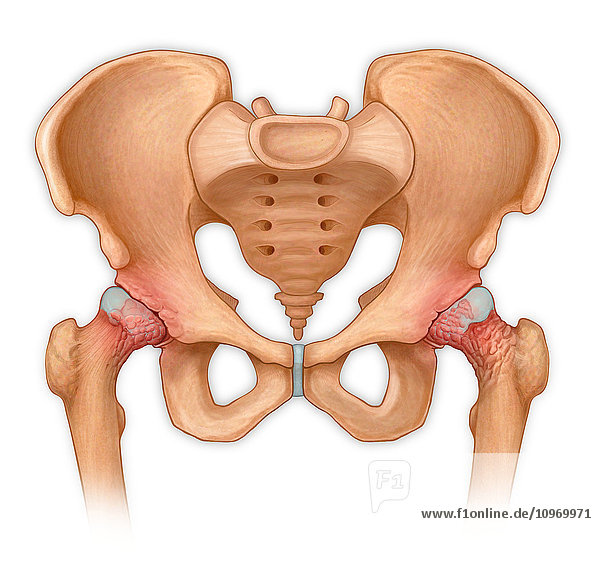Anterior view of pelvis with hip bones showing arthritis and osteophytes on femoral heads