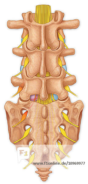 Posterior view of the lumbar spine showing a bulging disk and compressed spinal roots