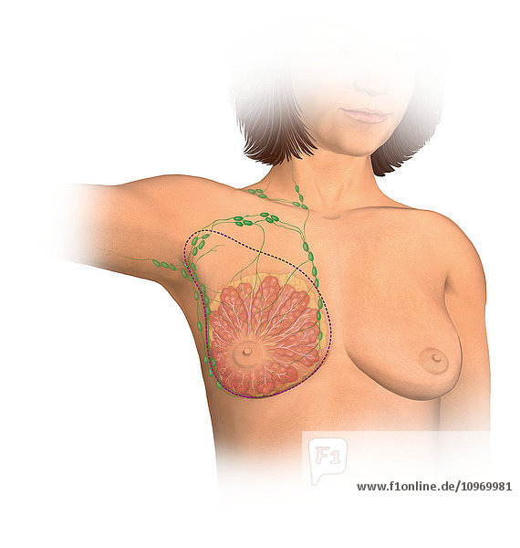 Anterior view female anatomy showing breast tissue and muscle affected by a radical modified mastectomy