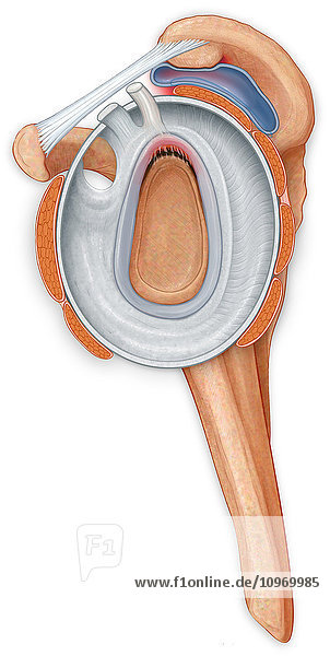 Open shoulder joint showing inflamed bursa from a bone spur and torn labrum