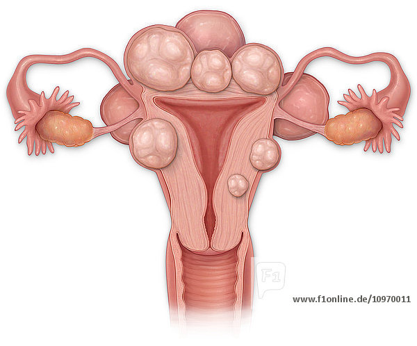 Female anterior cross sectional view of a uterus with fibroids  vagina  cervix  fallopian tubes and ovaries