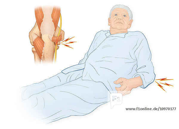 Illustration of an elderly man with anconeus epitrochlearis which is caused by compression of the ulnar nerve