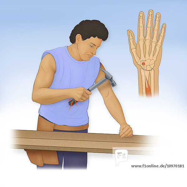 Illustration of the FlexorCarpi Radialis Tendinitis  caused by repetitive trauma such as prolonged use of a heavy hammer