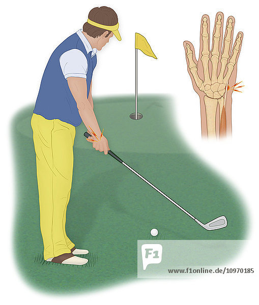 A golfer can develop an acute extensor carpi ulnaris tendinitis injury from improper grip of a golf club and over use