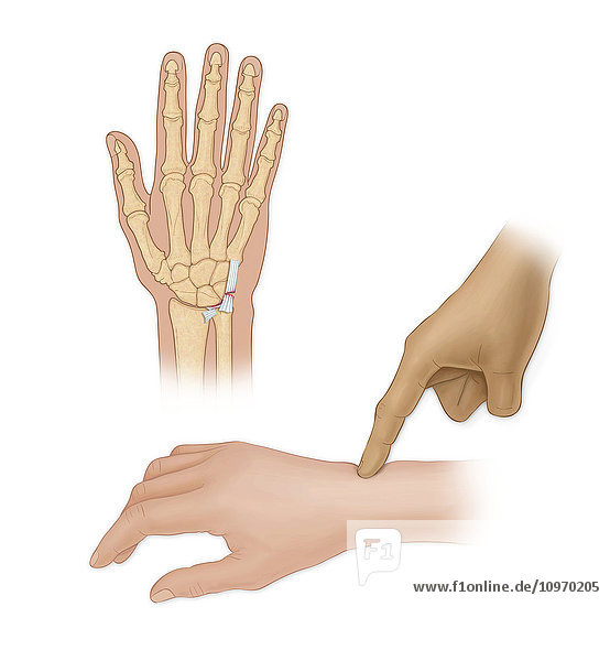 Hand bones with injury and finger pointing to wrist
