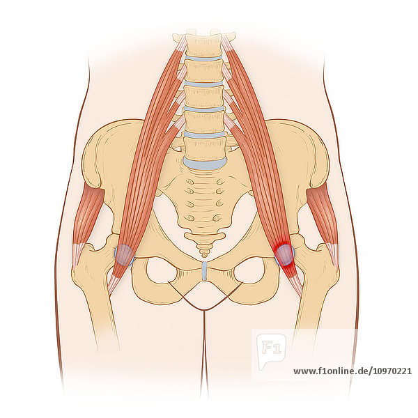 Repetitive activities like aerobics that involve lifting up the knee can cause trauma to the iliopectinate bursa  lead to iliopectinate bursitis