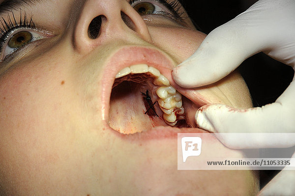 Gingivatransplantat. Entnahme des Transplantats und Nähen. Der Zahnarzt entfernt ein Stück Zahnfleisch aus dem Gaumen. Die Schleimhaut wird entweder oberhalb oder unterhalb des Periosts entfernt. Das Periost ist die Membran  die den Knochen bedeckt.