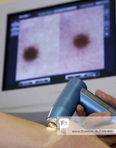 Hautarzt  Dermatologe untersucht Patientin mittels Videodermatoskopie  Deutschland  Europa