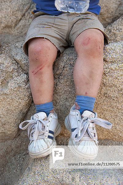 Child's scraped legs