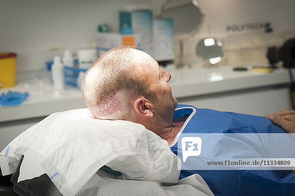Reportage in the Mozart plastic surgery clinic in Nice  France. FUE (Follicular Unit Extraction) hair transplant on a patient who has already undergone two strip harvesting sessions which have left scars. FUE will avoid this. FUE involves harvesting individual follicular units using a hollow needle that is 0.9-1.2mm in diameter  and reimplanting them in the bald patch. The end of harvesting.