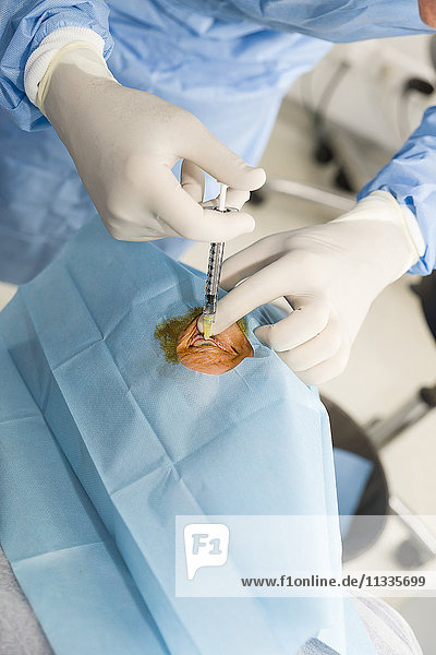 Reportage in der Klinik New Vision in Nizza  Frankreich. Diese Klinik ist eines der wichtigsten Zentren für refraktive Chirurgie in Frankreich und verfügt über modernste Technologie für alle Augenlaseroperationen. Intraokulare Injektion.