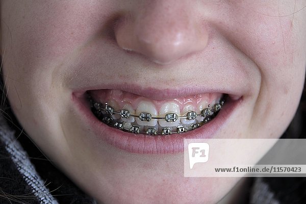 Fixed Braces  mouth of a girl  teenager  Upper Bavaria  Bavaria  Germany  Europe