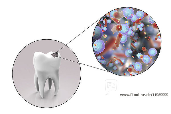 Karies an den Zähnen. Computergrafik eines Zahns mit Karies und einer Nahaufnahme der Bakterien  die die Kariesbildung verursachen.