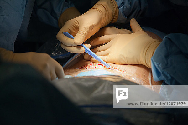 Reportage aus der Entbindungsstation des Krankenhauses Métropole Savoie in Chambéry  Frankreich. Geplante Entbindung per Kaiserschnitt. Einschnitt.