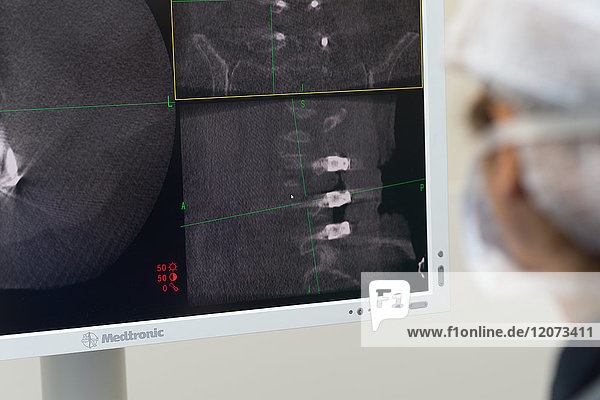 Reportage aus dem Operationssaal der orthopädischen Chirurgie im Krankenhaus Pasteur 2  Nizza  Frankreich. Markraumfreilegung und Arthrodese bei einem Patienten mit arthrosebedingter Lendenwirbelkanalstenose. Die Operation besteht darin  den Wirbelkanal von knöchernen Elementen zu befreien  die ihn zusammendrücken  und die Wirbelsäule mit einer Arthrodese zu verankern. Diese Operation wird mit dem O-Arm-System mit 3D-Bildern vor der Operation durchgeführt. Überwachung der korrekten Platzierung der Schrauben mit einem Scanner.