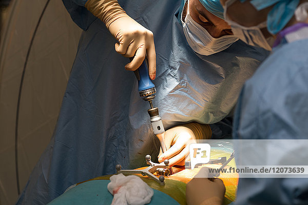 Reportage aus dem Operationssaal der orthopädischen Chirurgie im Krankenhaus Pasteur 2  Nizza  Frankreich. Markraumfreilegung und Arthrodese bei einem Patienten mit arthrosebedingter Lendenwirbelkanalstenose. Die Operation besteht darin  den Wirbelkanal von knöchernen Elementen zu befreien  die ihn zusammendrücken  und die Wirbelsäule mit einer Arthrodese zu verankern. Diese Operation wird mit dem O-Arm-System mit 3D-Bildern vor der Operation durchgeführt. Einsetzen der Schrauben.