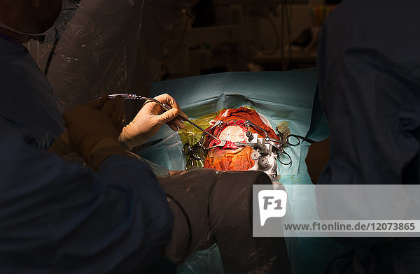 Reportage aus dem Operationssaal der stereotaktischen Neurochirurgie im Krankenhaus Pasteur 2  Nizza  Frankreich. Behandlung der Parkinson-Krankheit durch tiefe Hirnstimulation. Bei dieser Technik werden Elektroden in das Gehirn implantiert  die die abnorme elektrische Aktivität des Gehirns modulieren. Der Raum ist mit einem O-Arm-Scanner für die OP-Vorbereitung und dem NeuroMate  einem stereotaktischen Roboter  ausgestattet. Der Roboter ermöglicht es den Chirurgen  ihre Operationstechnik zu optimieren und zuverlässiger zu machen  und der O-Arm ermöglicht 3D-Bilder in Echtzeit  um die Präzision  Sicherheit und Effizienz der Operation zu verbessern. Vorbereitung von zwei Bohrlöchern.