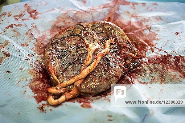 Placenta outside uterus just after childbirth in the hospital