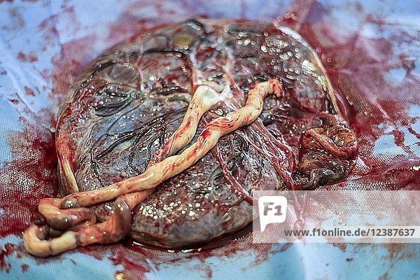 Placenta outside uterus just after childbirth in the hospital
