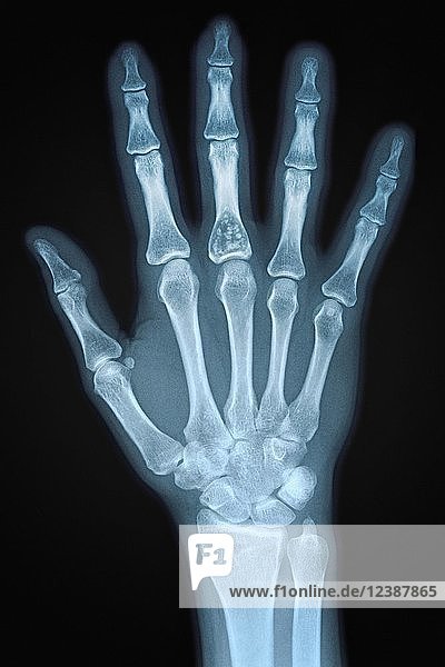 Röntgenbild der Hand einer erwachsenen Frau