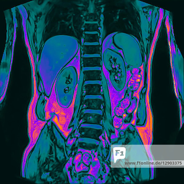 MRT-Untersuchung des frontalen Abdomens eines 60-jährigen männlichen Patienten mit Nierenstein