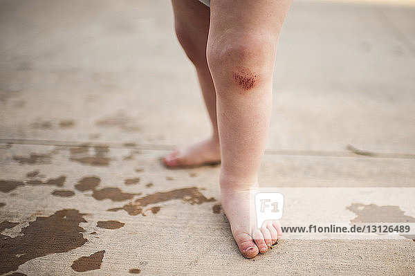 Low section of baby boy with wounded leg standing outdoors