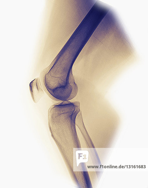 normales Knie-Röntgenbild einer 33-jährigen Frau