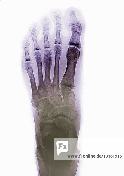 X-ray of normal foot