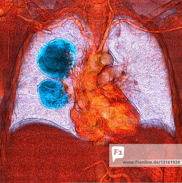 Metastatic melanoma of the lungs
