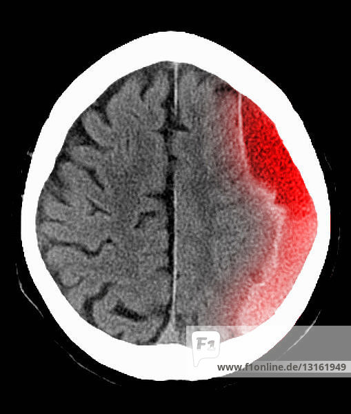 CT scan of the head with subdural hematoma