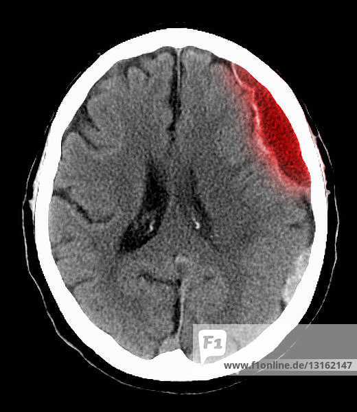 CT-Untersuchung des Kopfes mit subduralem Hämatom