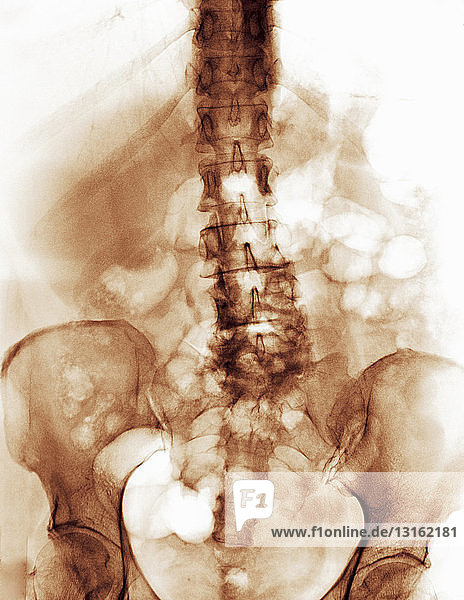 Röntgenaufnahme der Wirbelsäule mit degenerativen arthritischen Veränderungen