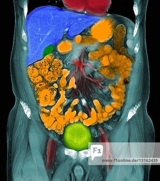 CT-Untersuchung von Metastasen bei Prostatakrebs