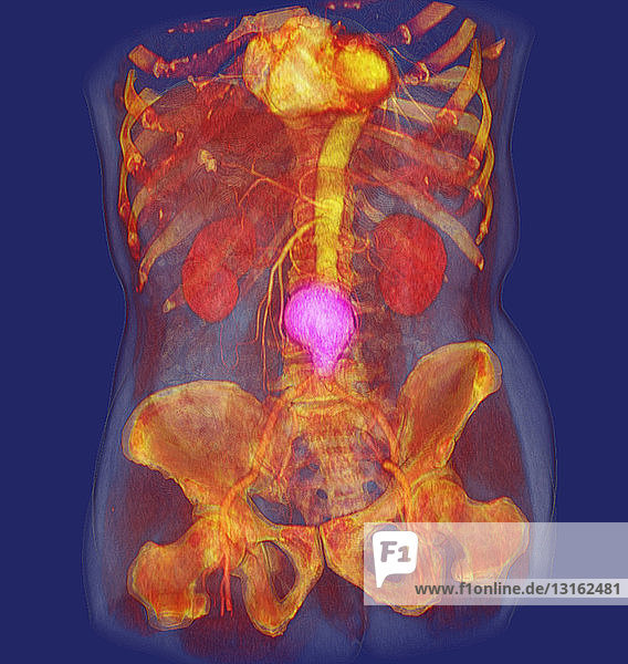 CT-Scan-Bild  das ein abdominales Aortenaneurysma zeigt