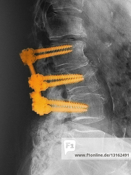 lumbar spine with spinal fusion hardware