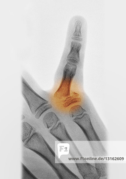 Röntgenaufnahme der Hand mit Fraktur einer proximalen Phalanx