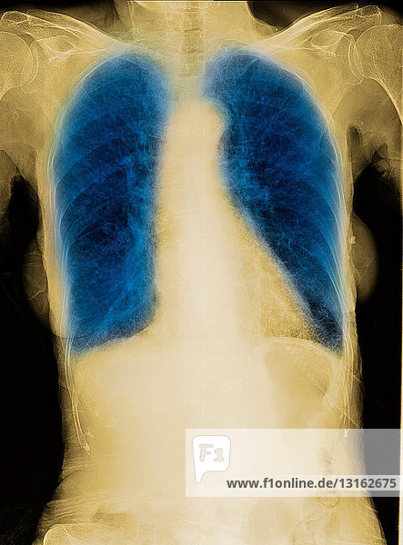 CXR einer älteren Raucherin mit COPD