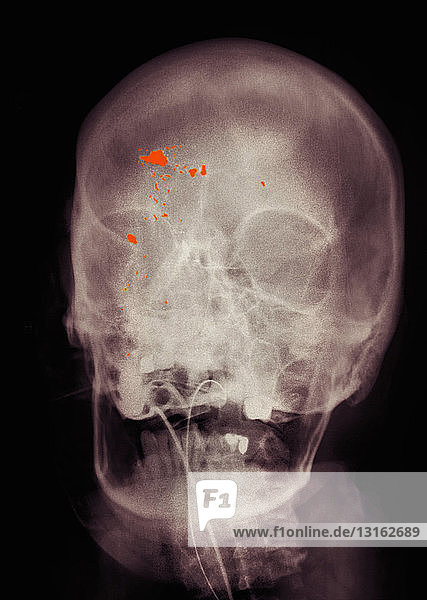 Farbige Röntgenaufnahme des Schädels mit Schussverletzung