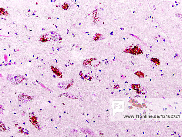 Parkinson-Krankheit  Substantia nigra  Lewy-Körperchen