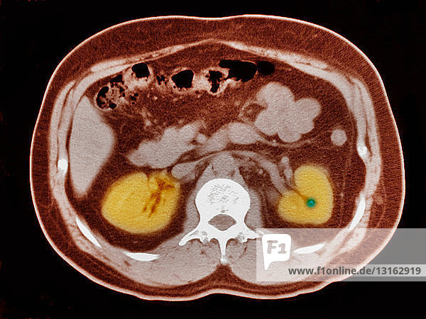 CT-Untersuchung des Abdomens mit kleinem Nierenstein